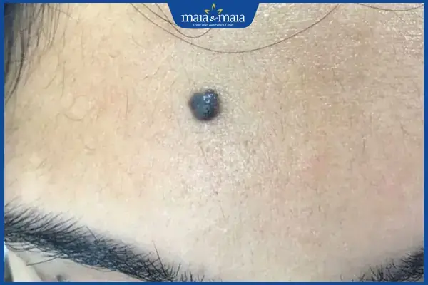 Bói Tướng Số Qua Nốt Ruồi