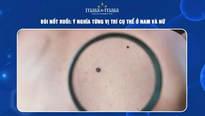 Bói Tướng Số Qua Nốt Ruồi