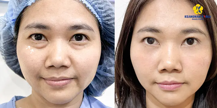 Bọng Mắt Trong Tướng Số