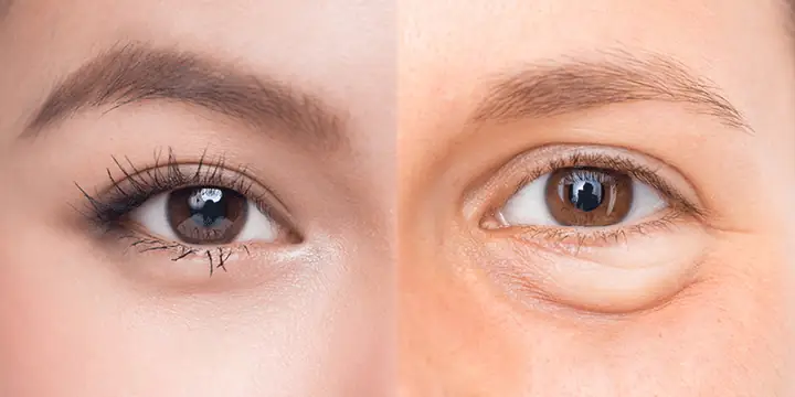 Bọng Mắt Tướng Số