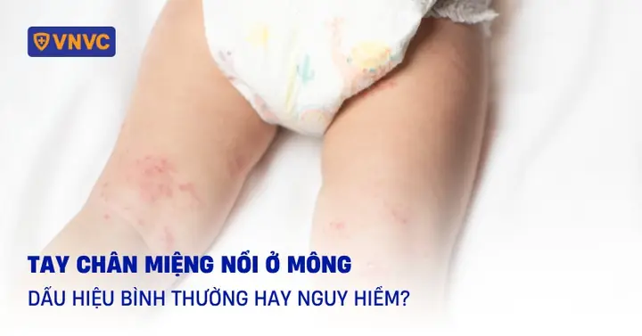 Có Lỗ Nhỏ Ở Mông Tướng Số