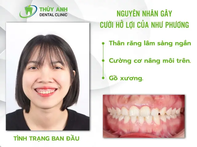Cười Hở Lợi Trong Tướng Số
