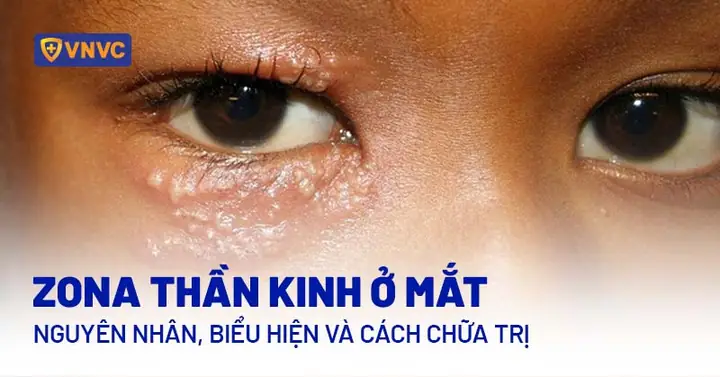 Hay Bị Bệnh Về Mắt Và Tướng Số