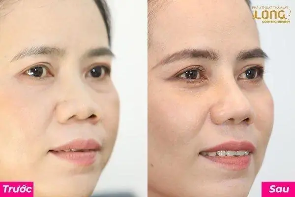 Làm Mũi Có Thay Đổi Tướng Số