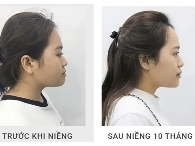 Làm Răng Có Thay Đổi Tướng Số