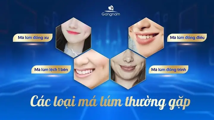 Má Lúm Đồng Tiền Trong Tướng Số