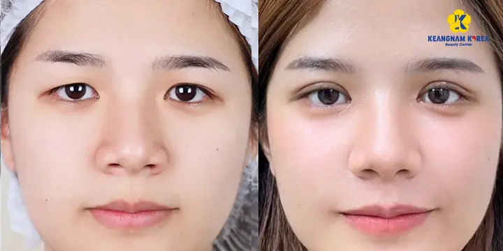 Mắt Lệch Mí Tướng Số