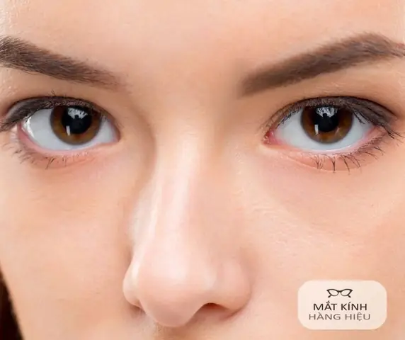 Mí Trên Che Mất Lòng Đen Tướng Số