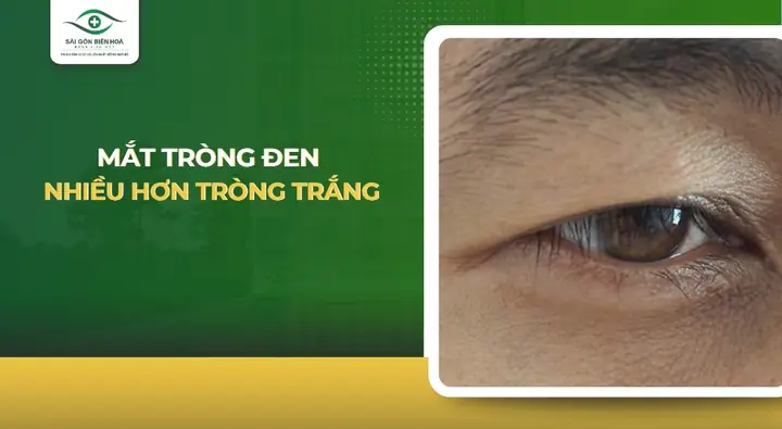 Mí Trên Che Mất Lòng Đen Tướng Số