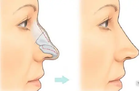 Mũi Gãy Tướng Số