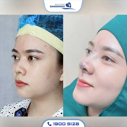 Nâng Mũi Có Ảnh Hưởng Đến Tướng Số