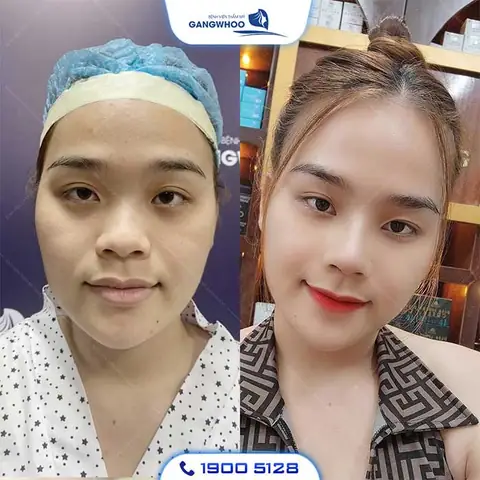 Nâng Mũi Có Ảnh Hưởng Đến Tướng Số Không Nâng Mũi Có Ảnh Hưởng Đến Tướng Số Không