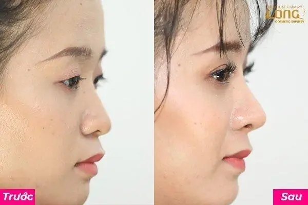 Nâng Mũi Có Làm Thay Đổi Tướng Số