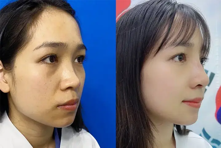 Nâng Mũi Có Làm Thay Đổi Tướng Số