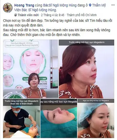 Nâng Mũi Có Thay Đổi Tướng Số Nâng Mũi Có Thay Đổi Tướng Số