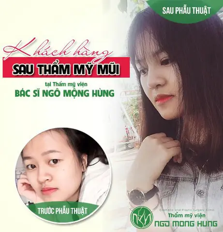 Nâng Mũi Có Thay Đổi Tướng Số