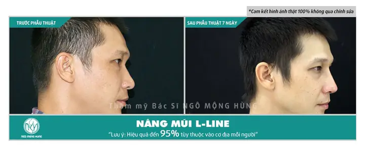 Nâng Mũi Có Thay Đổi Tướng Số Không
