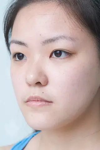 Nâng Mũi Thay Đổi Tướng Số Webtretho