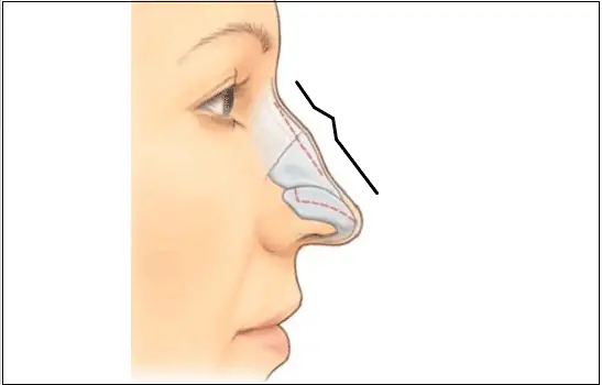 Nâng Mũi Thay Đổi Tướng Số Webtretho Nâng Mũi Thay Đổi Tướng Số Webtretho