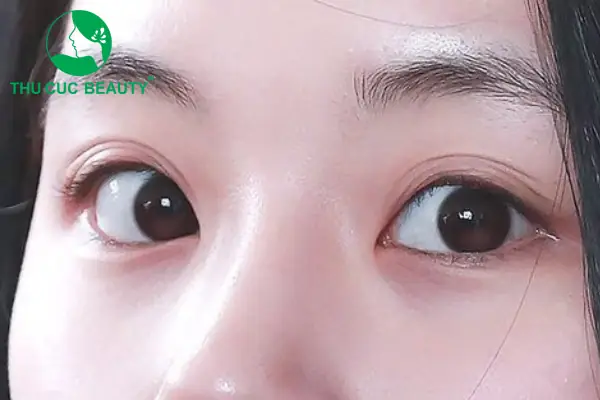 Nhăn Mắt Và Tướng Số