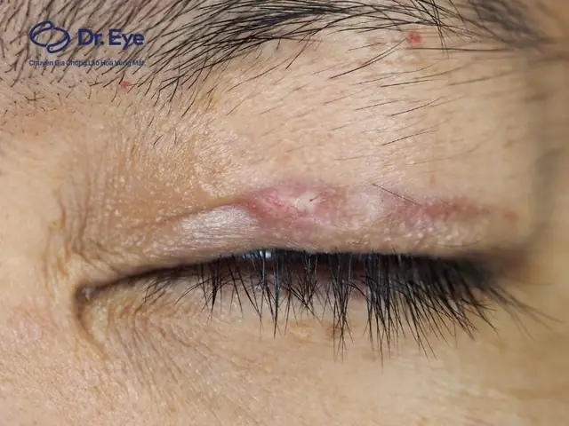 Nhấn Mí Có Ảnh Hưởng Đến Tướng Số