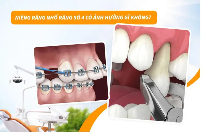 Niềng Răng Có Ảnh Hưởng Đến Tướng Số