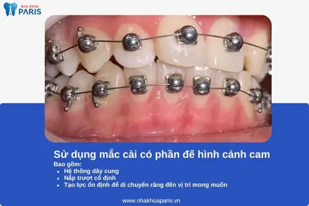 Niềng Răng Có Ảnh Hưởng Đến Tướng Số