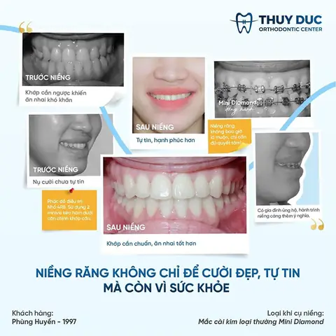 Niềng Răng Có Thay Đổi Tướng Số Niềng Răng Có Thay Đổi Tướng Số