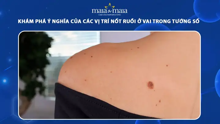 Nốt Ruồi Vai Phải Tướng Số Nốt Ruồi Vai Phải Tướng Số