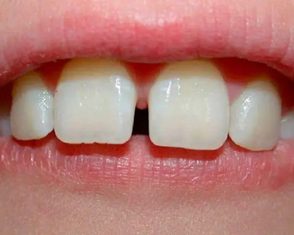 Răng Cửa Hở Trong Tướng Số