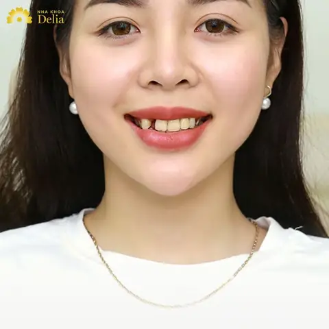 Răng Khểnh Trong Tướng Số Răng Khểnh Trong Tướng Số