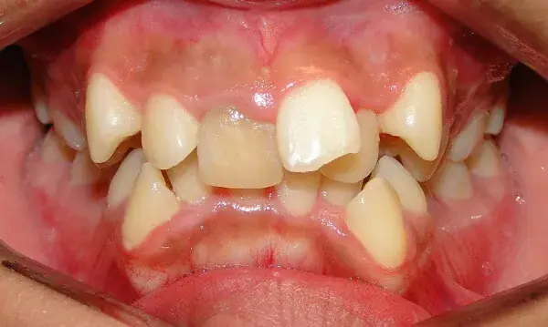 Răng Khểnh Trong Tướng Số Răng Khểnh Trong Tướng Số