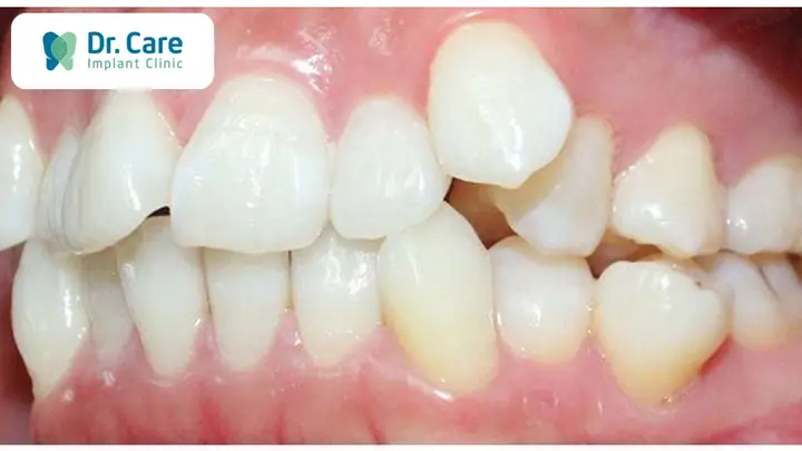 Răng Mọc So Le Tướng Số Răng Mọc So Le Tướng Số