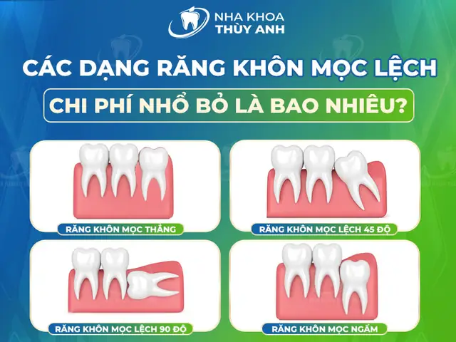 Răng Mọc So Le Tướng Số