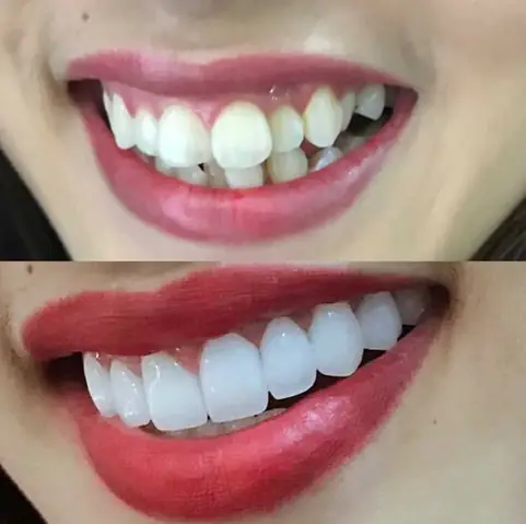 Răng Thụt Vào Trong Tướng Số Răng Thụt Vào Trong Tướng Số