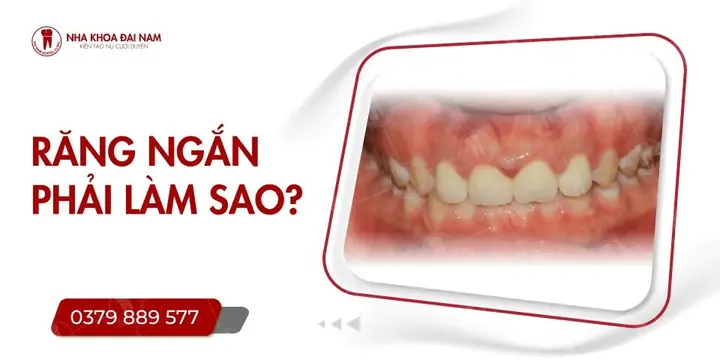 Răng To Tướng Số