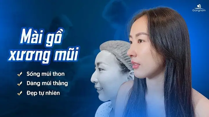 Sống Mũi Bị Gồ Tướng Số
