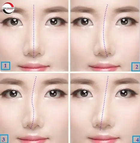 Sống Mũi Lệch Tướng Số