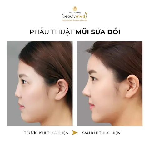 Sửa Mũi Ảnh Hưởng Tới Tướng Số Không