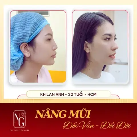 Sửa Mũi Có Làm Thay Đổi Tướng Số
