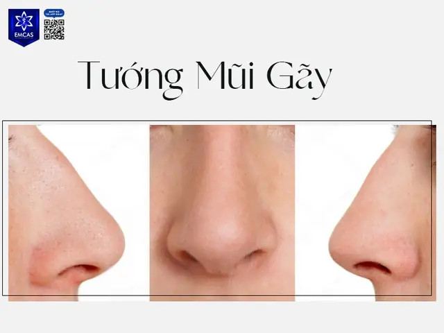 Sửa Tướng Mũi Đàn Ông