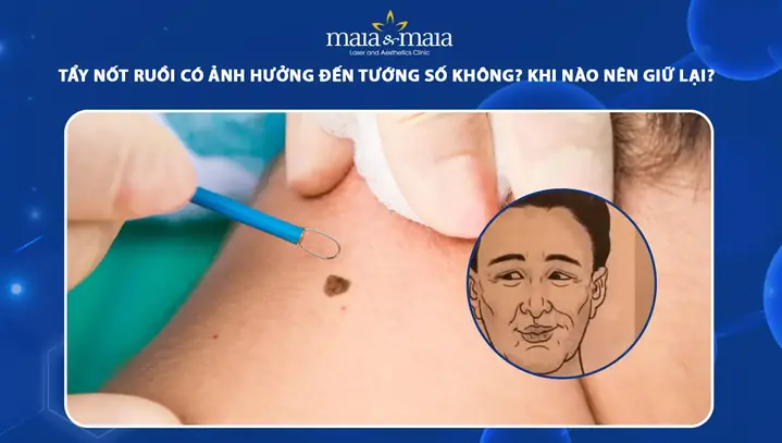 Tẩy Nốt Ruồi Có Ảnh Hưởng Đến Tướng Số