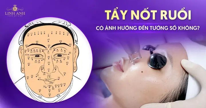 Tẩy Nốt Ruồi Có Ảnh Hưởng Đến Tướng Số Không