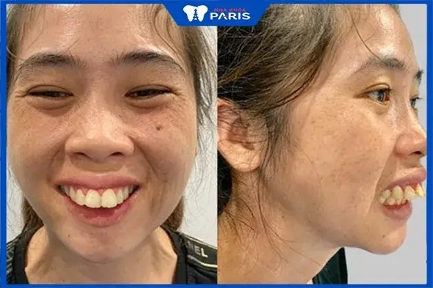 Thay Đổi Tướng Số Trên Khuôn Mặt
