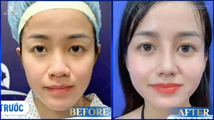 Thế Nào Là Tướng Mũi Xấu