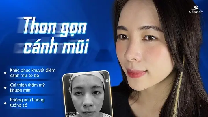 Thu Gọn Cánh Mũi Có Ảnh Hưởng Đến Tướng Số