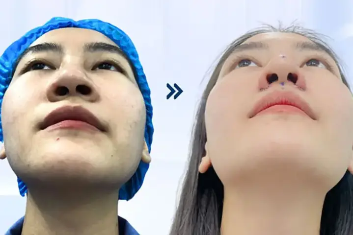 Thu Gọn Cánh Mũi Có Ảnh Hưởng Đến Tướng Số