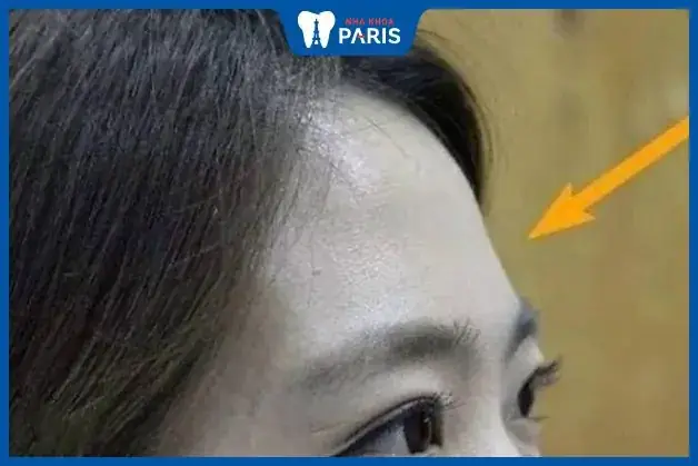 Trán Hóp 2 Bên Tướng Số