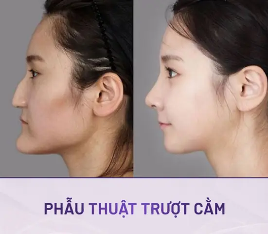 Tướng Cằm Chìa Ra