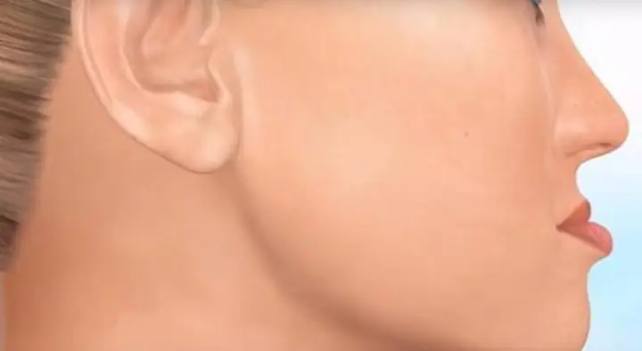 Tướng Cằm Chìa Ra Ngoài